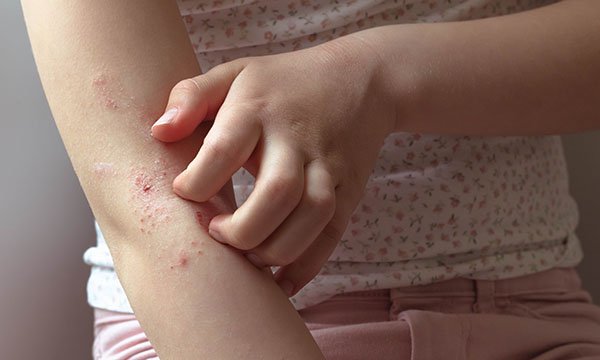 Supporting children, young people and families to self-manage atopic eczema