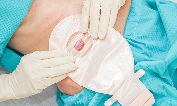 A stoma bag is positioned on a patient’s abdomen by gloved hands