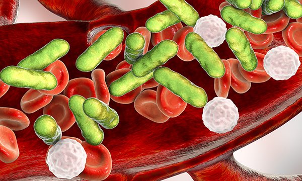 Sepsis: an overview of the signs, symptoms, diagnosis, treatment and pathophysiology