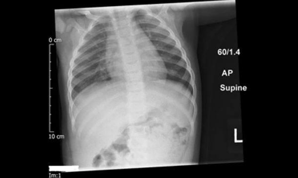Indications for chest X-rays in children